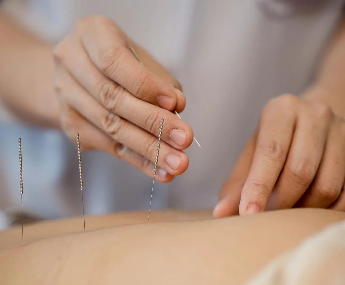 What is Acupuncture?