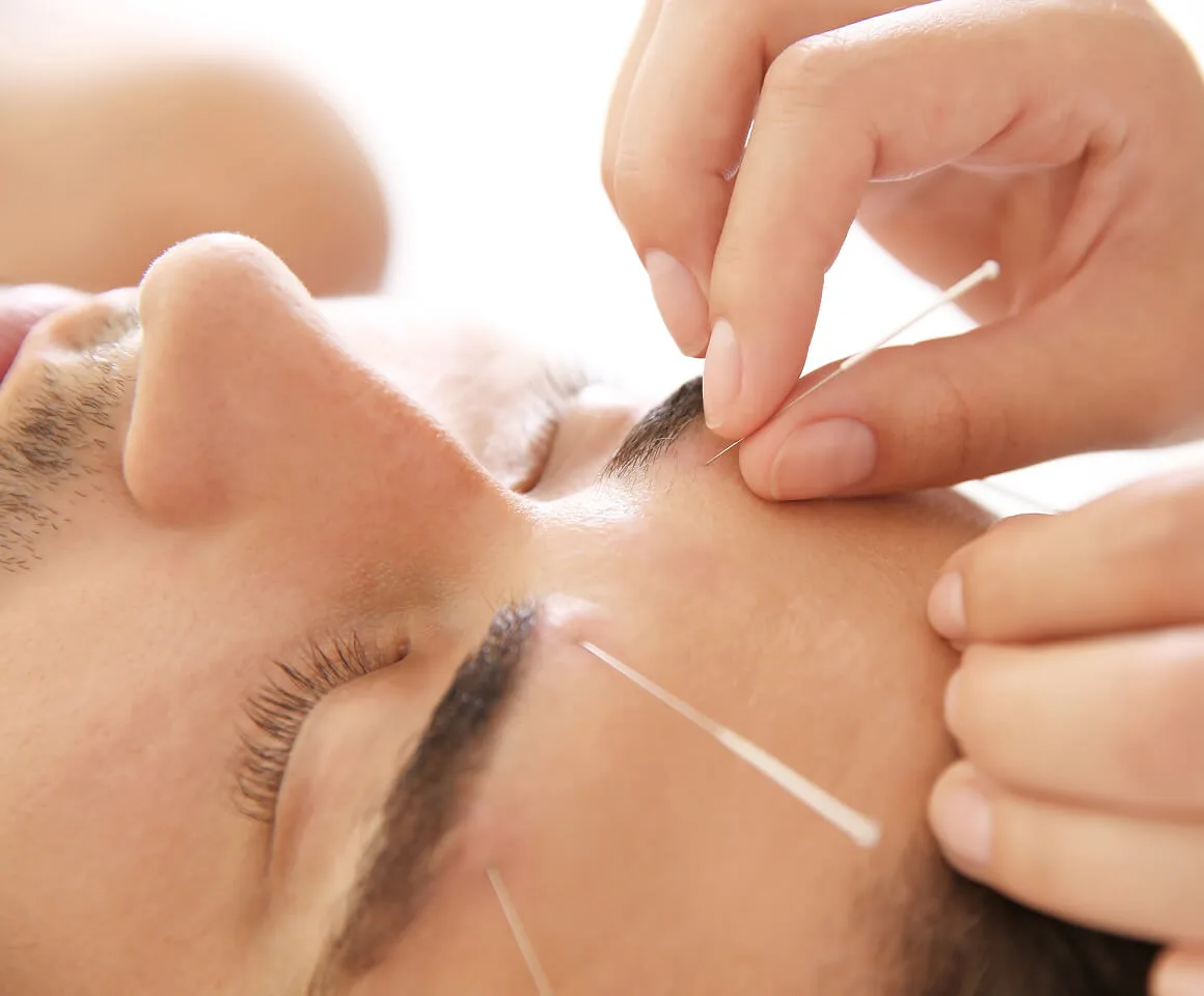 Acupuncture for facial rejuvenation